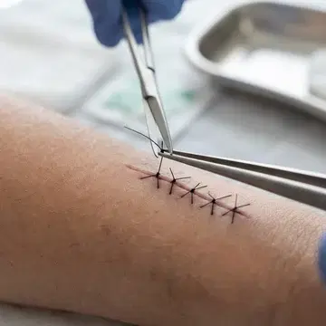 Stitch Removal
